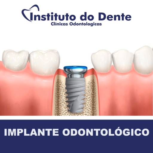 Comprar o produto de IMPLANTE em Odontologia pela empresa Instituto do Dente em Marília, SP por Solutudo
