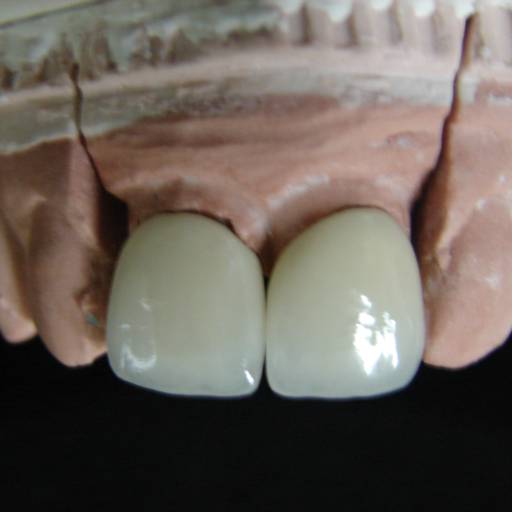 Próteses Odontológicas Estéticas em Resende, RJ por Clínica Torquato