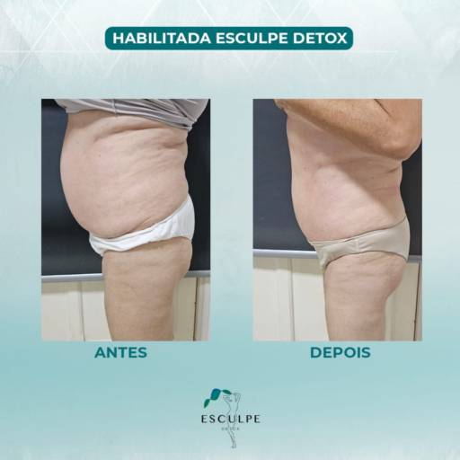 Massagem Método Esculpe Detox em Avaré – Corpo Leve e Remodelado