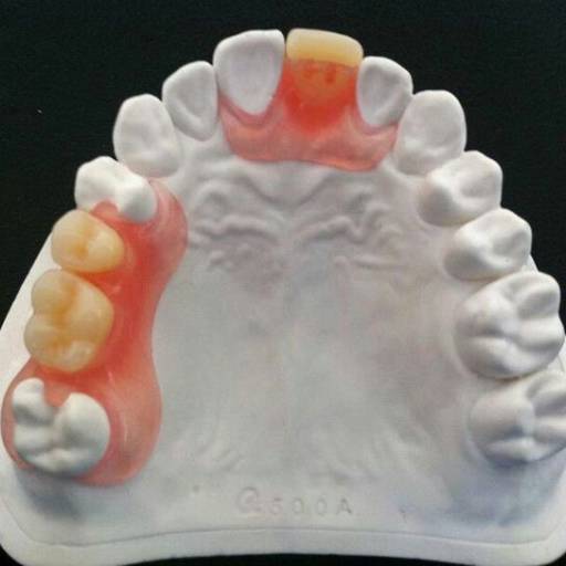 Prótese Fléxivel (silicone) por Dra. Nathália Quirino Bueno