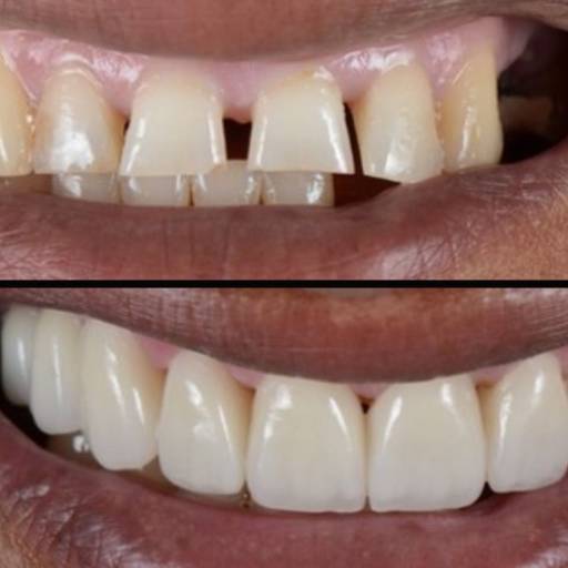 Lentes Dentais de Porcelana em Resende, RJ por Clínica Torquato