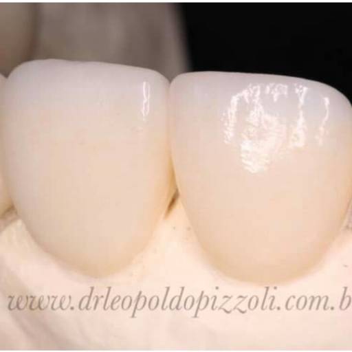 Coroas e Lentes de Contato  por Dr. Leopoldo P. Pizzoli Cirurgião Dentista