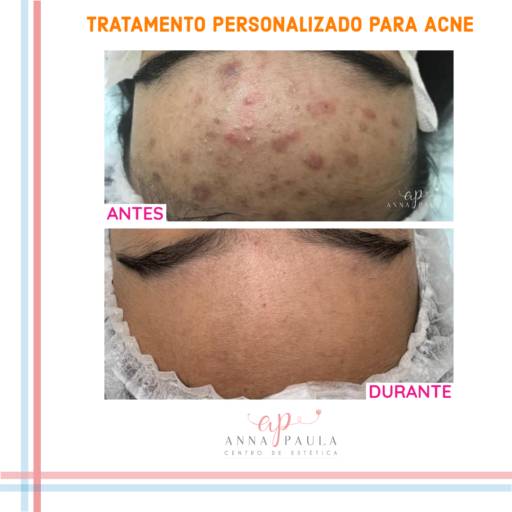 Tratatamento para Acne