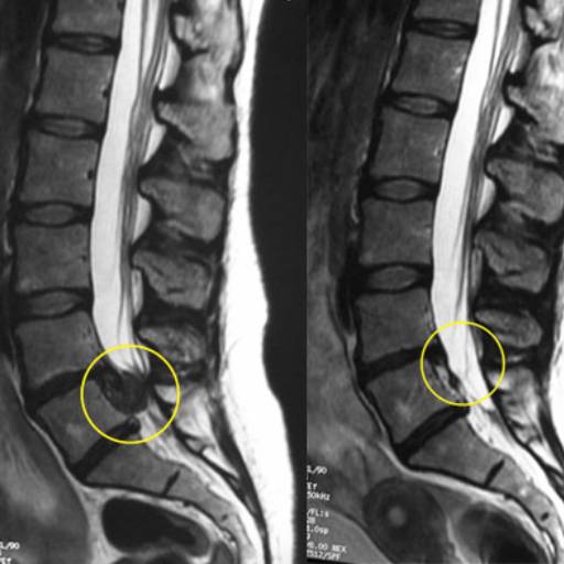 Tratamento Conservador nas Hérnias de Disco Cervicais e Lombares por Body & Motion Pilates, Fisioterapia e Quiropraxia em Atibaia