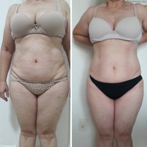 Tratamento para Gordura Localizada em Avaré – Corpo Definido e Firme
