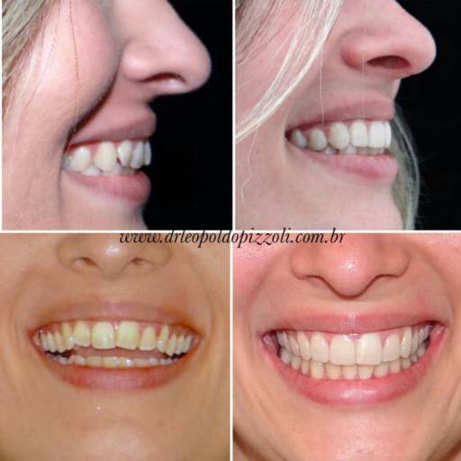 Odontologia Estética  por Dr. Leopoldo P. Pizzoli Cirurgião Dentista