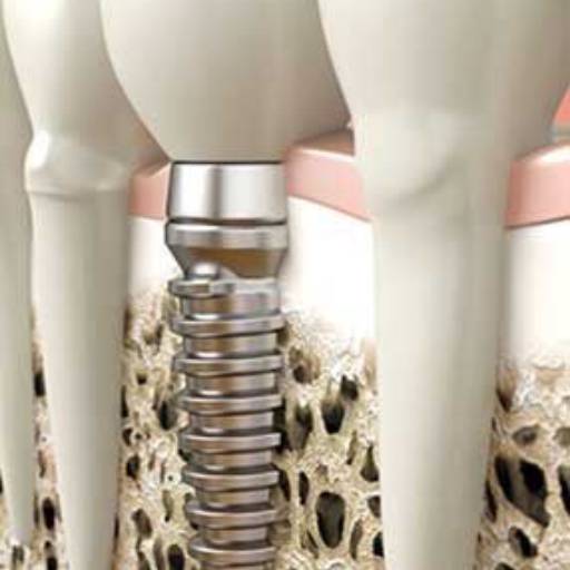 Implantes dentários em Bauru