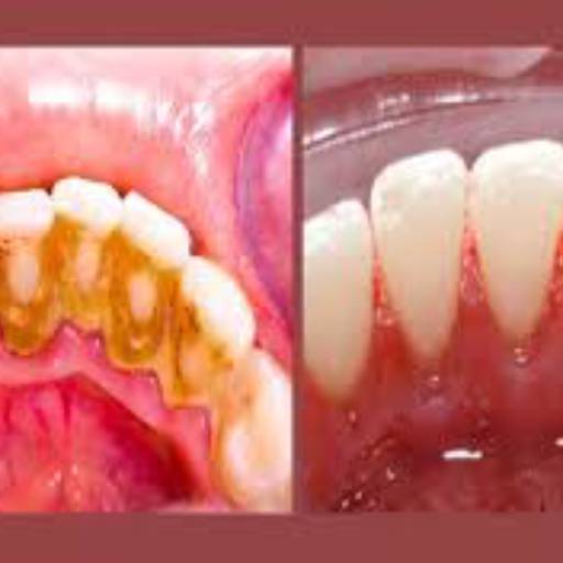 Limpeza Dental por Odontologia Campagnone 