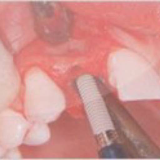 Implante Dentário por  Dr. Dante Cavecci Júnior - CRO 74.097