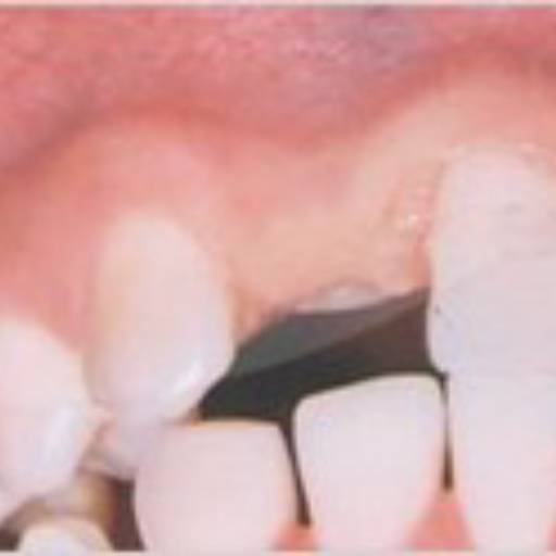 Implante Dentário por  Dr. Dante Cavecci Júnior - CRO 74.097
