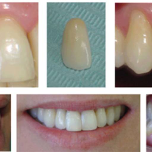 Prótese fixa de um elemento (um dente)