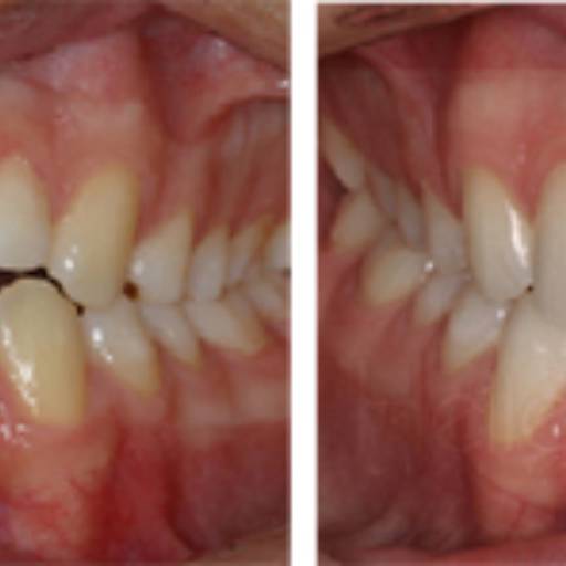 Prótese fixa de quatro elementos (quatro dentes)