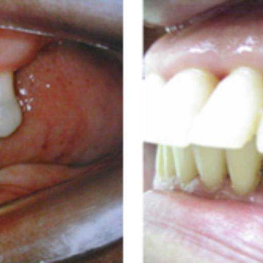 Prótese parcial removível