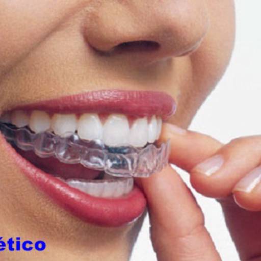 Ortodontia adulto por Dra Gabriela Antunes Silva CRO-SP 88092