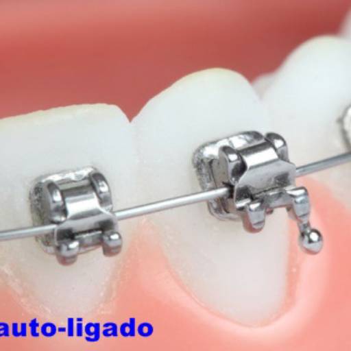 Ortodontia adulto por Dra Gabriela Antunes Silva CRO-SP 88092