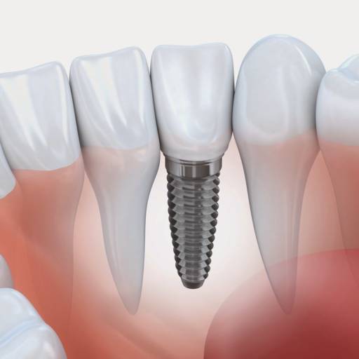Implante por Odontologia Orlandi