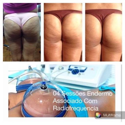 Tratamento para celulite em Avaré