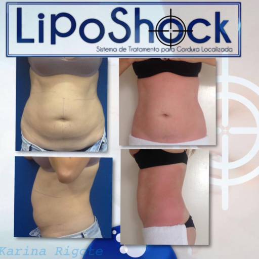 LipoShok Detox em Avaré