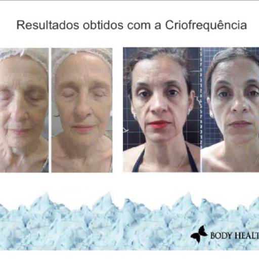 Criofrequência  por Toda Bonita Beleza e Estética