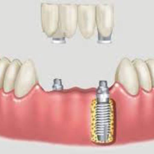 Próteses e implantes dentários. Atendemos crianças e adultos. por COBS Odontologia Dr. Luiz Henrique Sartori CROSP 106967