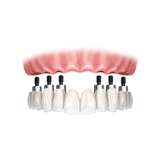 Comprar o produto de Próteses Dentárias em Avaré em Saúde pela empresa Oralsin Implantes Avaré em Avaré, SP por Solutudo