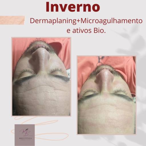 Dermaplaning com ativos( removendo a camada superficial)
