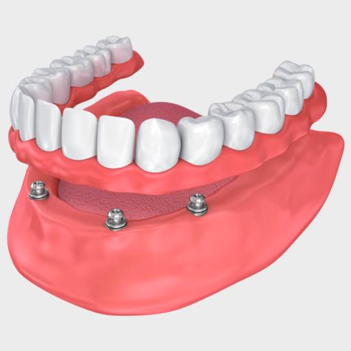 Comprar o produto de Implante Dentário em Saúde pela empresa Oral Sin Implantes - CRO 138524 em Botucatu, SP por Solutudo