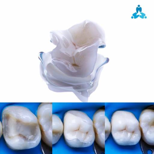 Comprar o produto de Restauração em Porcelana em Odontologia pela empresa Art Dentaire - Harmonizando Sorrisos em Itapetininga, SP por Solutudo
