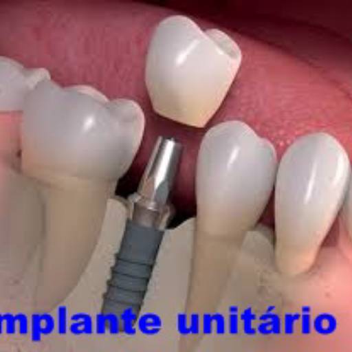Prótese Dentária por Dra Gabriela Antunes Silva CRO-SP 88092