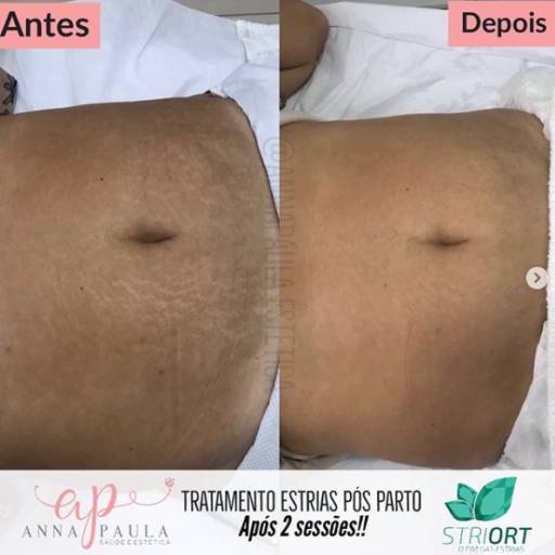 Tratamento de estrias pós parto