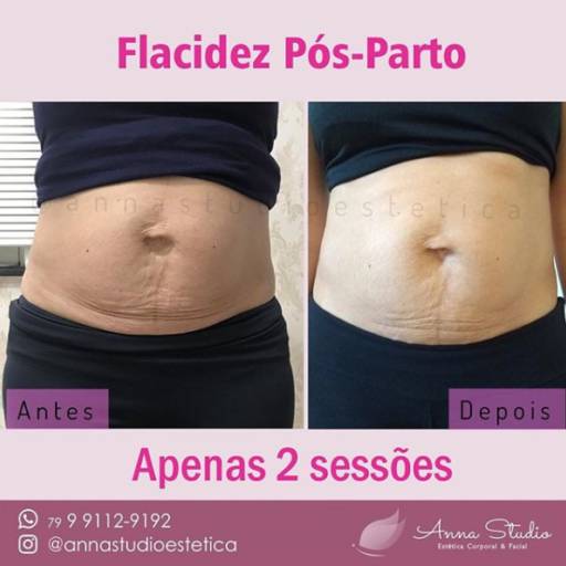 Flacidez pós parto em Aracaju, SE por Estética Anna Paula