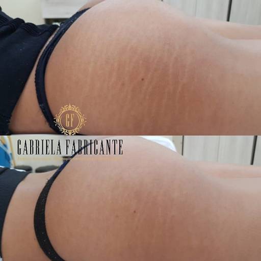 Eliminador de Estrias por Gabriela Fabricante Estética Avançada, Dermopigmentacão e Makeup artist