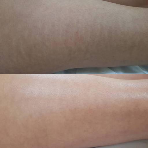 Eliminador de Estrias por Gabriela Fabricante Estética Avançada, Dermopigmentacão e Makeup artist