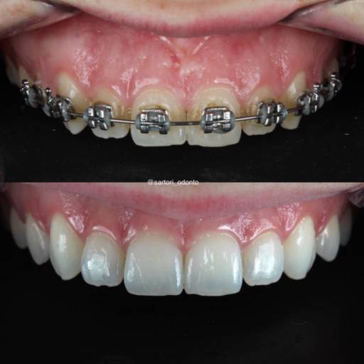 Aparelhos Fixos por Sartori Odontologia CR0-SP 19464 - RT: Patrícia Sartori CR0 106940