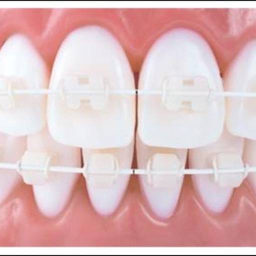 Aparelhos Fixos de Safira por Sartori Odontologia CR0-SP 19464 - RT: Patrícia Sartori CR0 106940