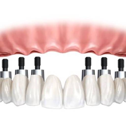 Implantes Dentários por Sartori Odontologia CR0-SP 19464 - RT: Patrícia Sartori CR0 106940