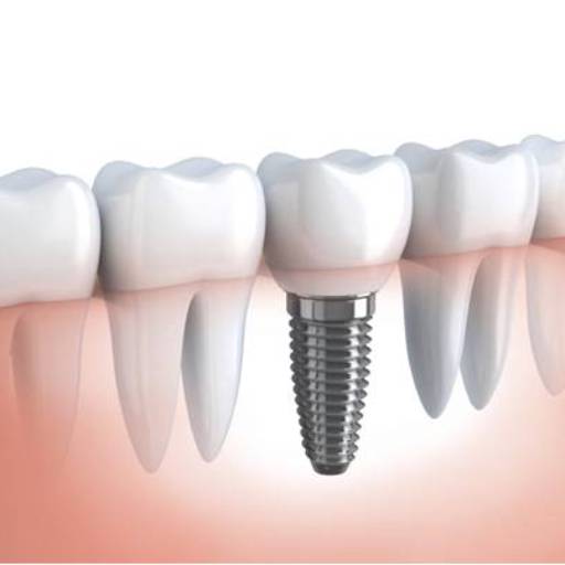 Implantes Dentários por Sartori Odontologia CR0-SP 19464 - RT: Patrícia Sartori CR0 106940