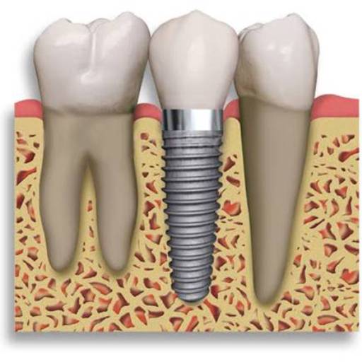Implantes ósseo integrado por Sartori Odontologia CR0-SP 19464 - RT: Patrícia Sartori CR0 106940