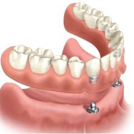 Prótese Overdenture por Sartori Odontologia CR0-SP 19464 - RT: Patrícia Sartori CR0 106940