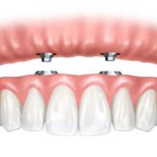 Prótese Protocolo por Sartori Odontologia CR0-SP 19464 - RT: Patrícia Sartori CR0 106940