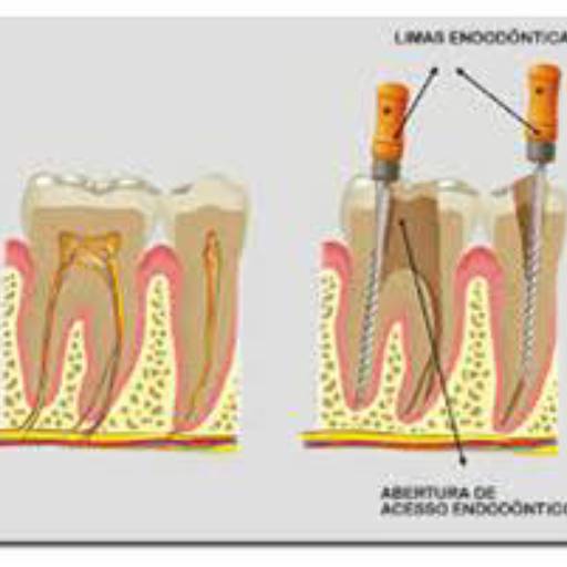 Tratamento dentário por Sartori Odontologia CR0-SP 19464 - RT: Patrícia Sartori CR0 106940