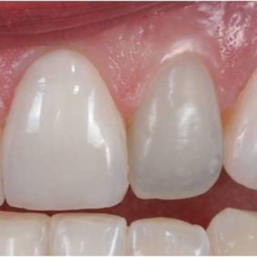 Clareamento  por Sartori Odontologia CR0-SP 19464 - RT: Patrícia Sartori CR0 106940