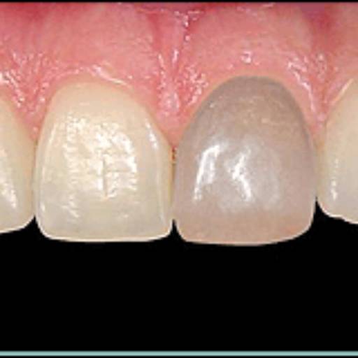 Clareamento  por Sartori Odontologia CR0-SP 19464 - RT: Patrícia Sartori CR0 106940