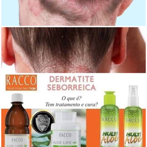 Tratamento Dermatite Seborreica