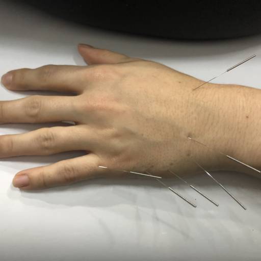 ACUPUNTURA por Livia Cruz Acupuntura