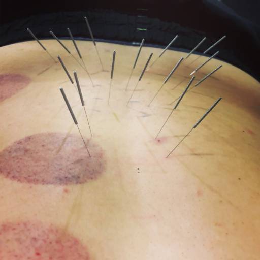 ACUPUNTURA por Livia Cruz Acupuntura