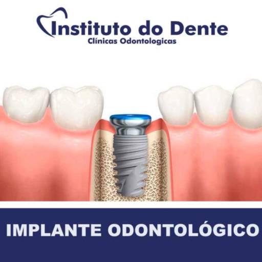Implante  por Instituto do Dente Sul