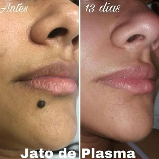 Jato de Plasma  por Hátila Muzi Esteticista