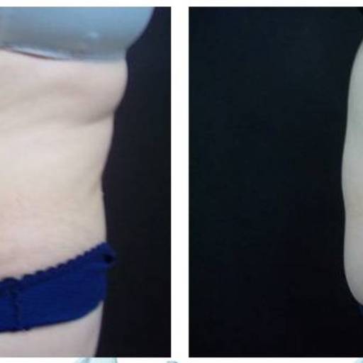 Criofrequência em Avaré por Clins - Clínica Integrada de Saúde