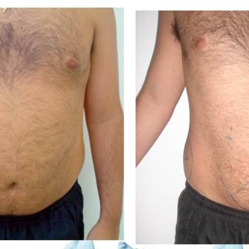 Criofrequência em Avaré